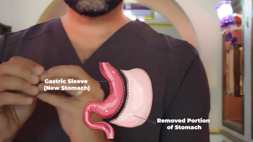 Gastric Sleeve